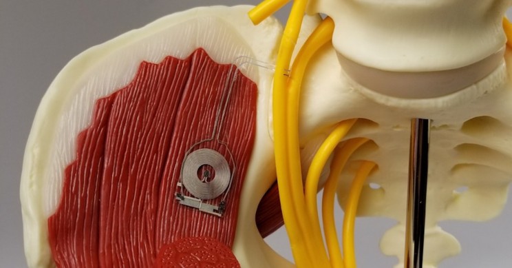 A Biodegradable Device For Healing Damaged Nerves