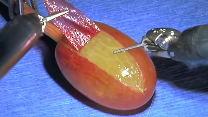 They Did Surgery On A Grape