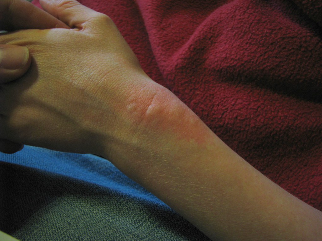 What is Aquagenic Urticaria?